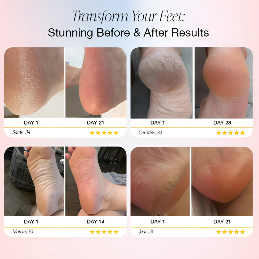 Velvae™ Electric Foot Callus Remover